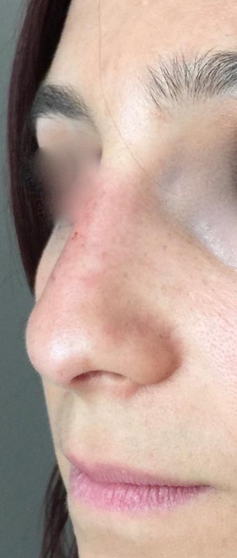 Après Rhinoplastie